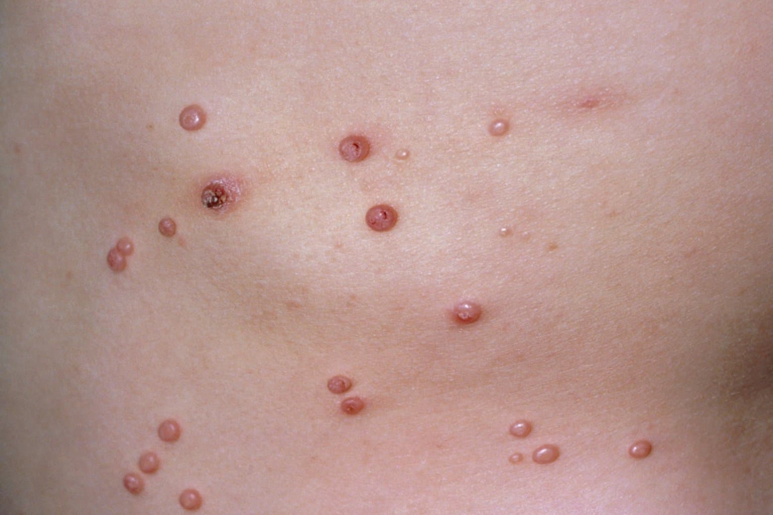 Scattered pink umbilicated papules across trunk skin, a sign of molluscum contagiosum.