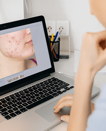 Doctor Reviewing Acne Case on Laptop Mobile