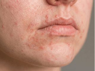/images/dermatitis/trail-10.png