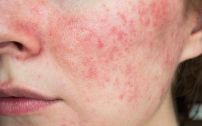 Rosacea