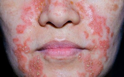 Perioral dermatitis