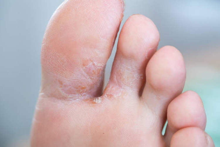 Athlete’s Foot: Causes, Symptoms, and Effective Treatment