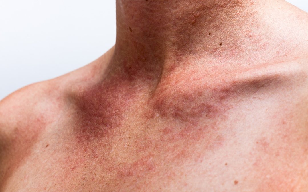 Polymorphic light rash (sun allergy)