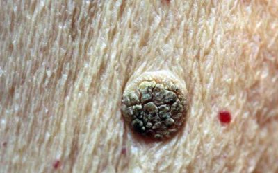 Seborrhoeic keratosis