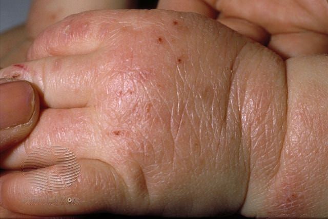 Atopic Dermatitis in Children: Causes, Symptoms, and Treatment