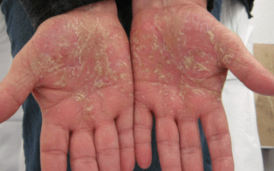 Palmoplantar pustulosis