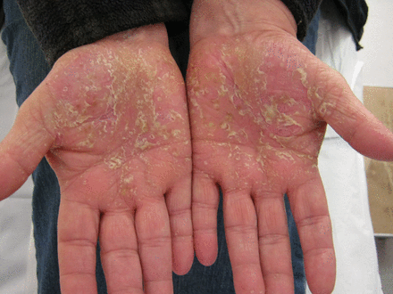 Palmoplantar pustulosis