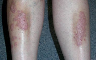 Lichen Planus: Causes, Symptoms, and Treatment Options