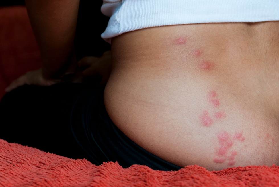 Insect Bites: Symptoms, Treatment, and Prevention Tips