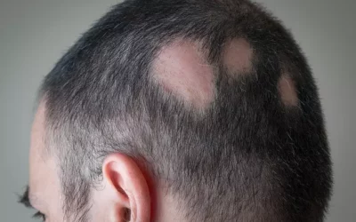 Focal alopecia