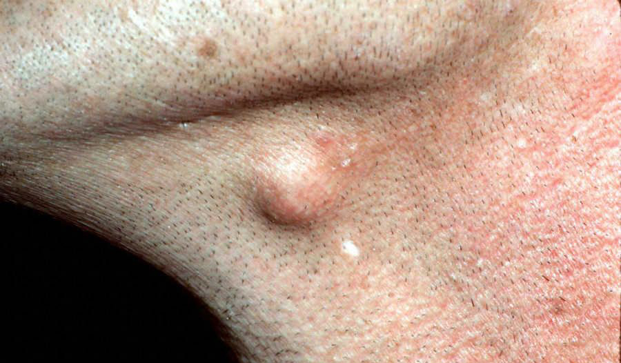 Epidermoid Cysts: Causes, Symptoms, and Treatment Options