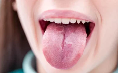 Geographic Tongue: Causes, Symptoms, and Treatment Options