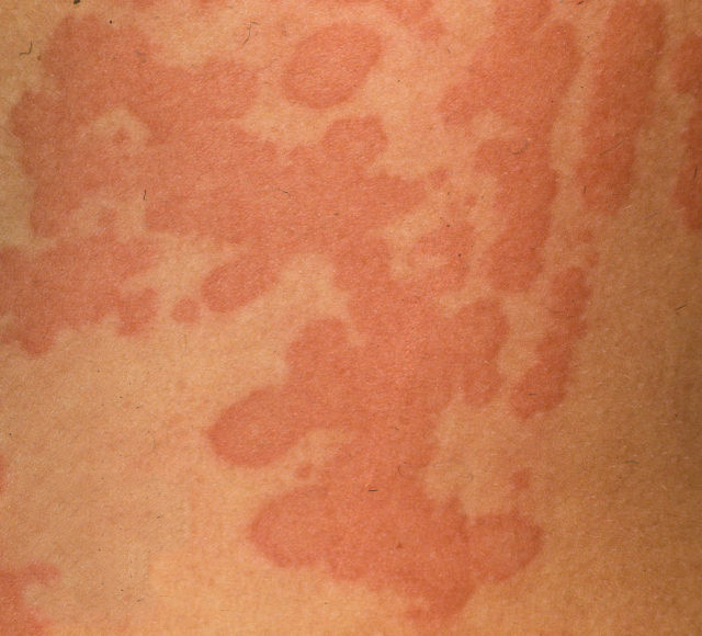 Acute Urticaria: Causes, Symptoms, and Treatment Options