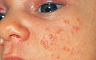 Skin Conditions in Newborns: Causes, Symptoms, and Care Tips