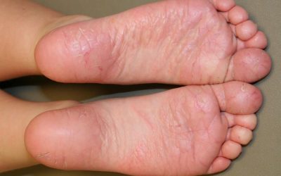 Juvenile plantar dermatosis